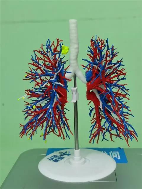 贵州省首例3D打印模型下的精准肺段切除手术在省医完成