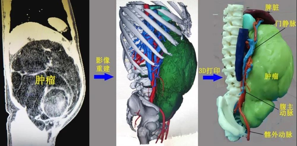 3D打印导航 精准拆除腹部16斤“巨弹”