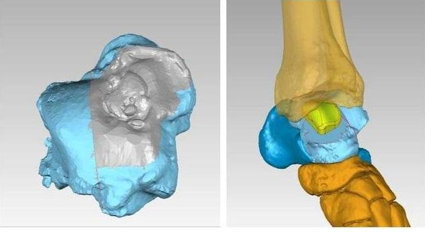 齐鲁医院手足外科成功完成3D打印距骨半髁置换手术