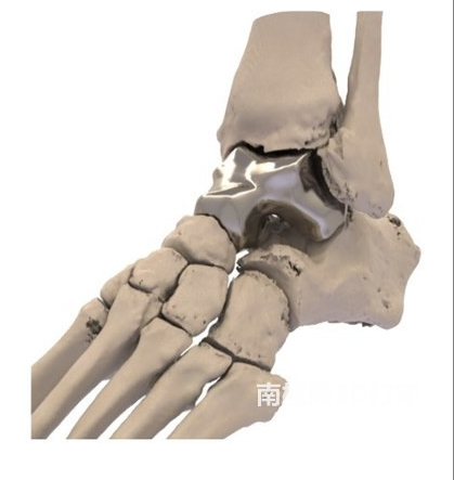 首个3D打印距骨植入物获得FDA批准，Additive Orthopaedics公司