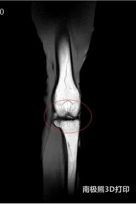 老年人膝盖疼、走路难？关节软骨老化有望用3D打印技术恢复如初
