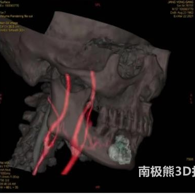 青岛城阳区人民医院运用3D打印为晚期舌癌患者完成颈动脉造影术加化疗栓塞术