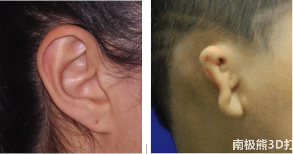 再造近乎完美耳朵！应用3D打印技术完美治疗小耳畸形