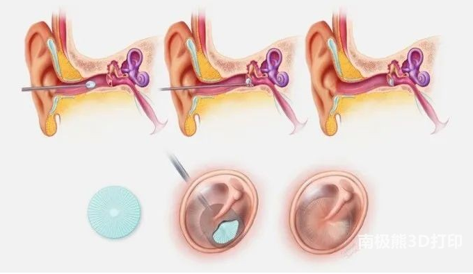 哈佛科学家研发的3D打印鼓膜修复贴片已经进入商业生产