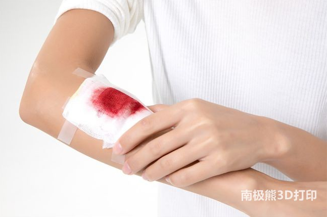 最新研究显示3D打印血浆可加速伤口愈合